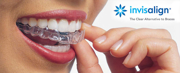 Invisalign being placed onto teeth