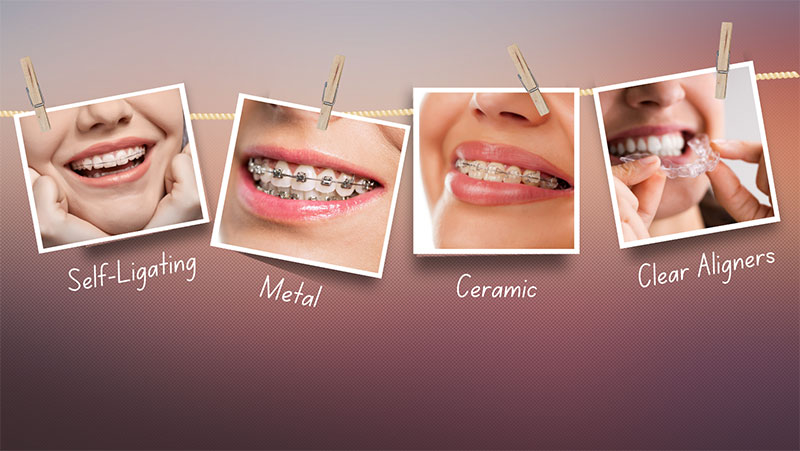 Image of types of braces