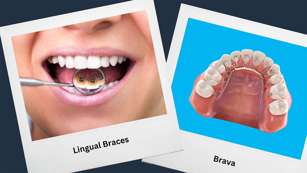 Pictures of lingual braces